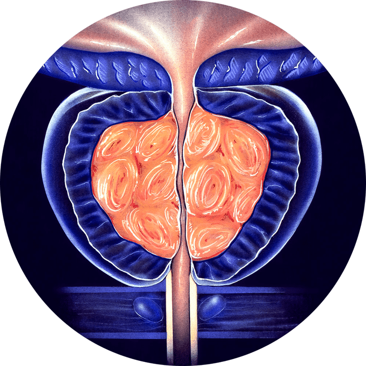 Chronesch Prostatitis