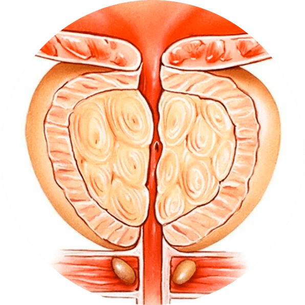 Konsequenze vun onbehandelt Prostatitis