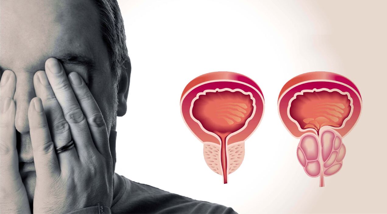 chronesch Prostatitis bei Männer