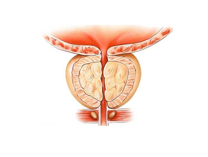 Behandlung vu Prostatitis mat Folk Heilmittel