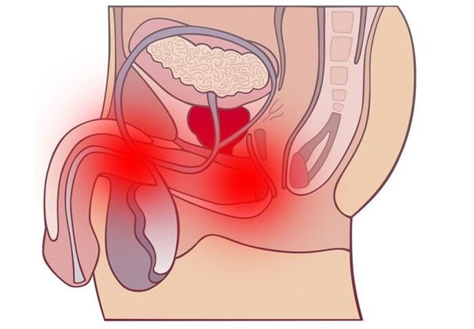 Prostatitis Behandlungsmethoden