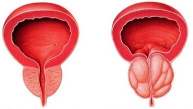 gesond an entzündegt Prostata mat Prostatitis